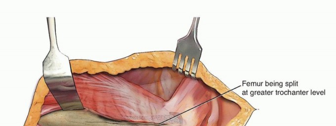 Illustration 5 for Well-Fixed THA Revisions: Precision in the Portion of the Osteotomy