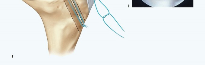 Illustration 31 for Symptomatic Knee? Meniscal Transplant for Anterior & Posterior Horns