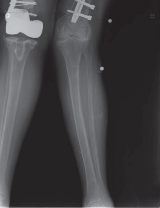 Illustration 16 for Mastering Valgus Total Knee Replacement: Techniques & Pitfalls