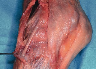 Illustration 25 for Mastering Valgus Total Knee Replacement: Techniques & Pitfalls