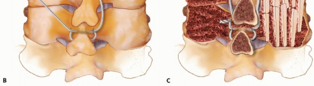 Illustration 8 for Achieve Stability: Posterior Cervical Lateral Mass Screw Fusion