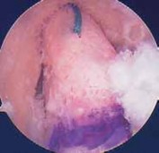 Illustration 74 for Optimizing Single-Bundle Anterior Cruciate Ligament Repair