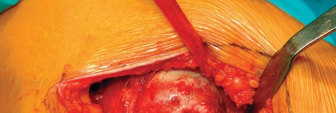 Illustration 53 for Direct Lateral Hip: Optimize Exposure with Sharp Curved Hohmann