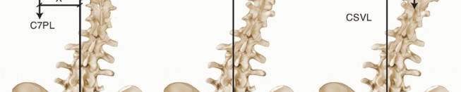 Illustration 8 for Adult Scoliosis: Uncover Causes & Find Lasting Back Pain Relief