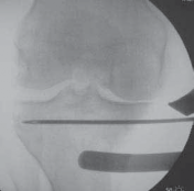 Illustration 27 for Guide Pin Assembly: Key to Flawless Upper Tibial Osteotomy