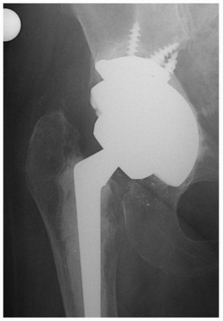 Illustration 4 for Uncemented Acetabular Revision: Optimizing Hemispherical Cup Use