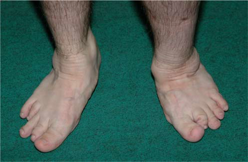 Illustration 5 for Understanding Multiple Epiphyseal Dysplasia: Orthopedic Cases