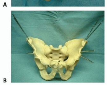 Illustration 9 for Emergency Fixation of the Pelvis: Control Bleeding & Restore Stability
