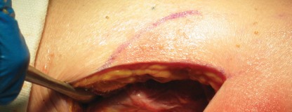 Illustration 2 for Minimally Invasive THA: Navigating Techniques, Benefits & Pitfalls