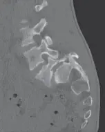 الانزلاق الفقاري (التكلّس الفقاري): دليل المريض الشامل للعلاج الفعّال مع الأستاذ الدكتور محمد هطيف