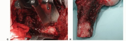 Illustration 18 for Mastering Femoral Metastases: Optimal Function for Femoris & Vastus