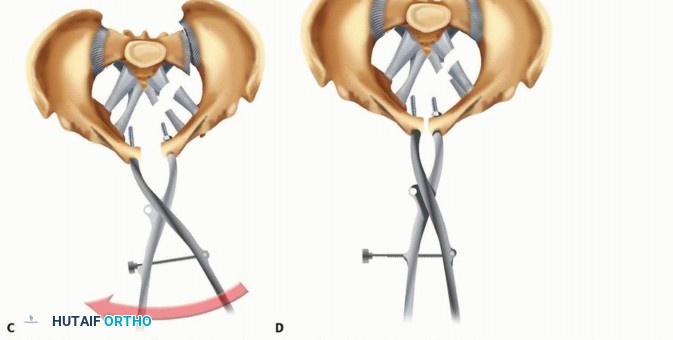 Illustration 18 for Achieve Stable Fixation of the Symphysis: Open Reduction