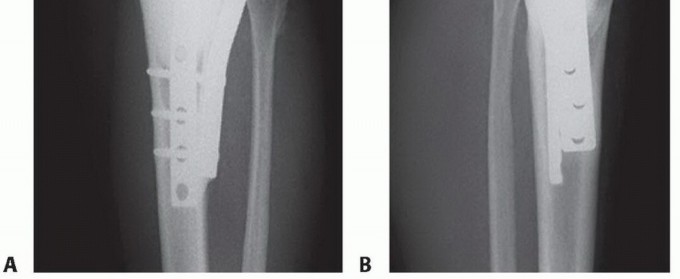Illustration 31 for Avoid Major Surgery: Bone Tumor Treatment with Liquid Nitrogen Pour