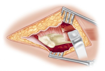 Illustration 7 for Intertrochanteric Femoral Osteotomy: Indications for Hip Preservation