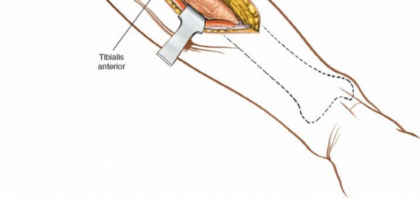 Illustration 64 for Surgical Access: Mastering the Tibia's Surface & Fibula Approaches