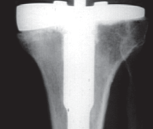 صورة طبية: مراجعة استبدال الركبة الجزئي الفاشل دليلك الشامل للعلاج الناجح في صنعاء
