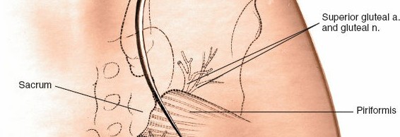 Illustration 2 for Simple & Safe Posterior Approach to the Sacroiliac: Key Techniques