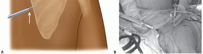 Illustration 21 for Solving Snapping Scapula: Is resection of the superomedial your option?