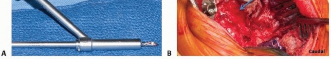 Illustration 9 for Addressing Cervical Spine Instability with Posterior Arthrodesis