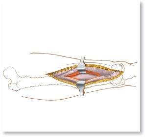 Illustration of lateral intermuscular septum - Dr. Mohammed Hutaif