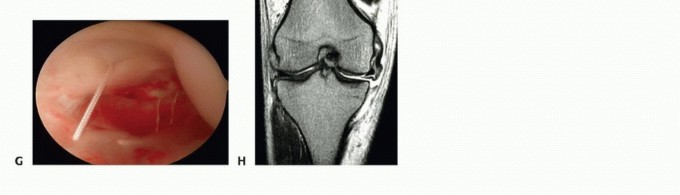 Illustration 3 for Repair & Recover from Collateral Ligament Injuries: Your Guide
