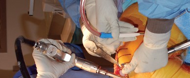 Illustration 27 for Mastering Gap Balancing in Revision TKA: Avoid Common Pitfalls