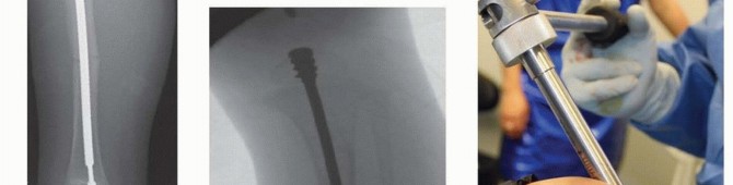 Illustration 30 for Less Pain, More Function: Fassier-Duval Nailing for Osteogenesis Imperfecta