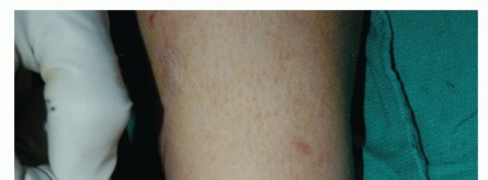 Illustration 60 for Restore Movement: Tendon Transfer for Common Peroneal Nerve Foot Drop