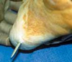 Illustration 12 for Solving Congenital Pseudarthrosis: Tibia with the Williams Rod