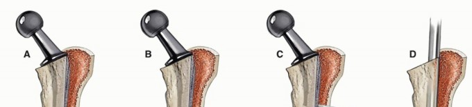 Illustration 15 for Well-Fixed THA Revisions: Precision in the Portion of the Osteotomy
