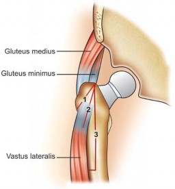 Standard Trochanteric Osteotomy: Key to Complex Hip Cases