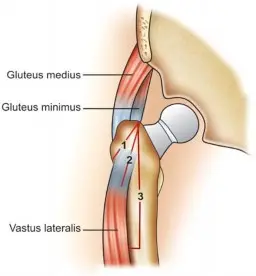 صورة توضيحية لـ قطع عظم المدور الكبير: حلول جراحية متقدمة لمشاكل مفصل الورك المعقدة