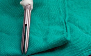 Illustration 32 for The Principles of Revision TKR: Avoid Pitfalls, Ensure Success