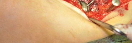 Illustration 18 for Collum Femoris Preserving: Achieve Better Primary Hip Outcomes