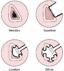 Illustration of osteomyelitis osteomyelitis osteomyelitis - Dr. Mohammed Hutaif