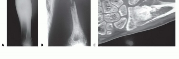 Illustration 9 for Free Vascularized Fibular Grafts: Solving Complex Bone Defects
