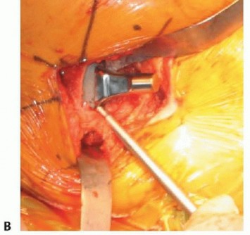 Illustration 39 for Hemiarthroplasty of the Hip: Indications & Types Explained