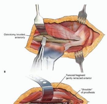Illustration 7 for Well-Fixed THA Revisions: Precision in the Portion of the Osteotomy
