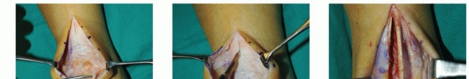 Optimize Pain Management with Proximal Ring Block for Ankle Arthrodesis