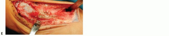 Ludloff Osteotomy: Comprehensive Surgical Guide & Biomechanics