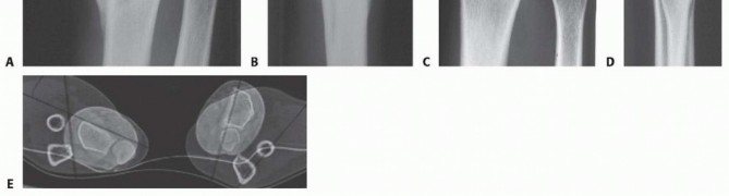 Illustration 3 for Precision Correction for Distal Radius Malunion