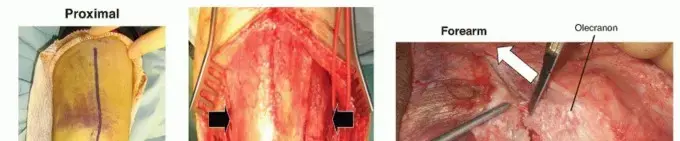 صورة توضيحية لـ جراحة المرفق: دليل المريض الشامل للتعافي والحياة الطبيعية مع الأستاذ الدكتور محمد هطيف