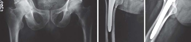 Illustration 52 for Optimizing Arthroplasty in Acute Fractures: Octopus System