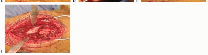 Enhance Recovery: Humeral Plate Fixation for Brachialis & Brachioradialis