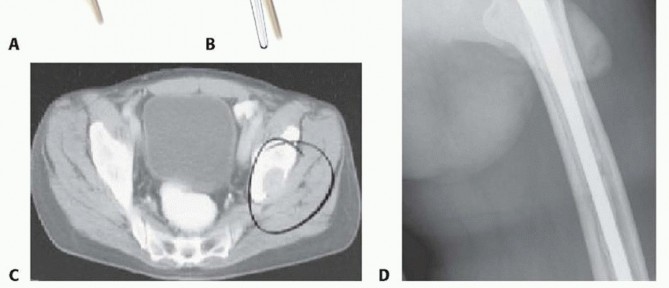 Illustration 3 for Regain Mobility: Total Hip Arthroplasty for Malignant Lesions