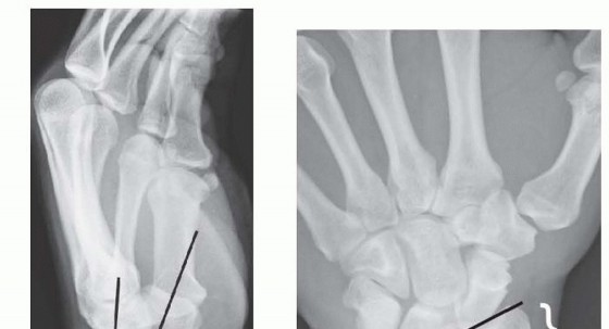 Illustration 3 for Effective K-Wire Fixation: Distal Radius Fractures Without External Fixation