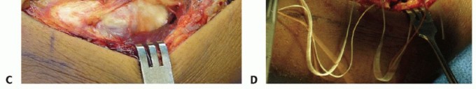 Illustration 30 for Radial Head & Neck Fractures: Mastering ORIF for Best Results