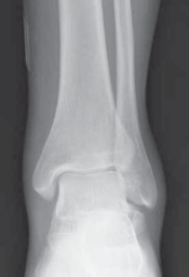 Illustration 6 for Talar Neck Fracture Treatment: Optimizing Recovery with ORIF