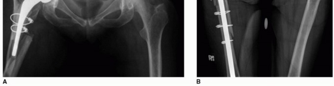 Illustration 8 for PJI of the Hip: Two-Stage Revision: When & How to Prepare