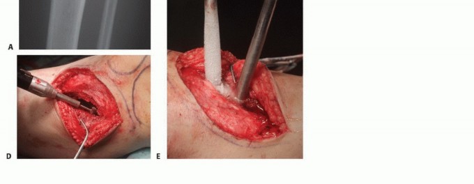 Illustration 16 for Avoid Major Surgery: Bone Tumor Treatment with Liquid Nitrogen Pour